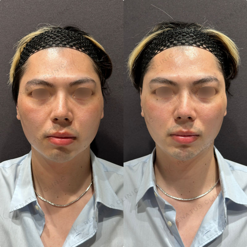 こめかみ・頬・目の下・顎ヒアルロン酸ボリューマ・ボルベラ・ボラックス症例写真