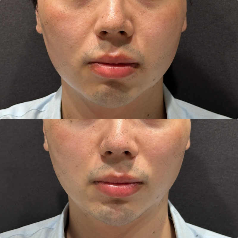 こめかみ・頬・目の下・顎ヒアルロン酸ボリューマ・ボルベラ・ボラックス症例写真