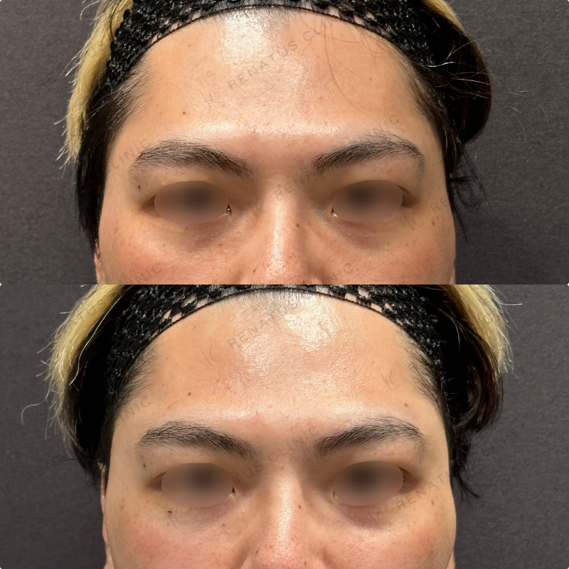 こめかみ・頬・目の下・顎ヒアルロン酸ボリューマ・ボルベラ・ボラックス症例写真