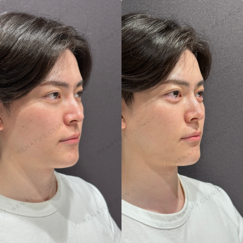 涙袋ヒアルロン酸ボルベラ症例写真