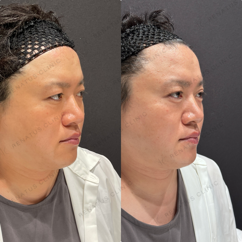 涙袋ヒアルロン酸ボルベラ症例写真