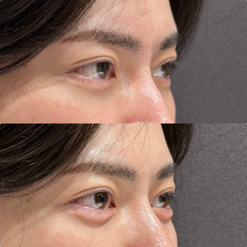 涙袋ヒアルロン酸ボルベラ症例写真