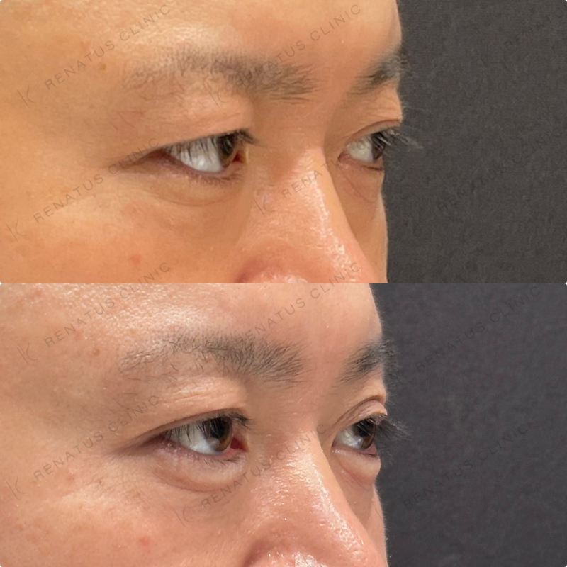 涙袋ヒアルロン酸ボルベラ症例写真