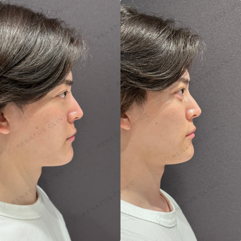 涙袋ヒアルロン酸ボルベラ症例写真