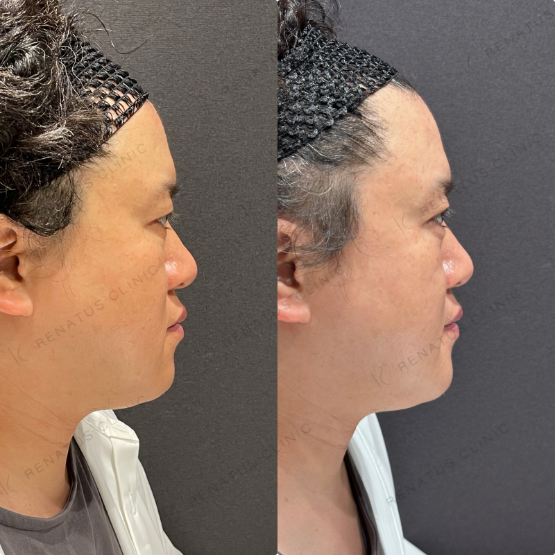 涙袋ヒアルロン酸ボルベラ症例写真