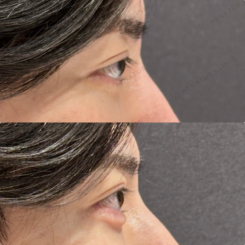 涙袋ヒアルロン酸ボルベラ症例写真