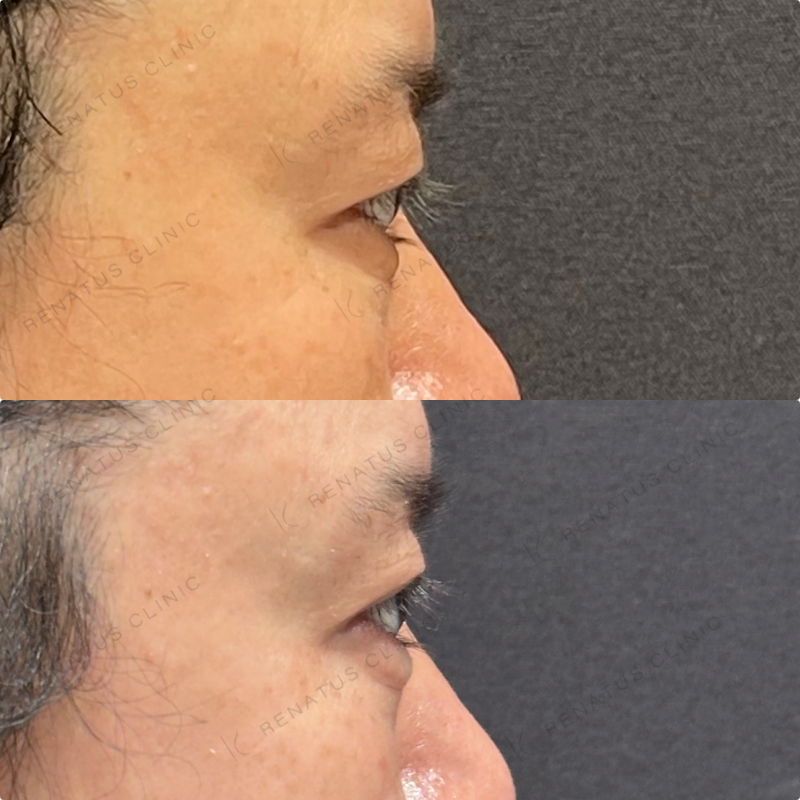 涙袋ヒアルロン酸ボルベラ症例写真