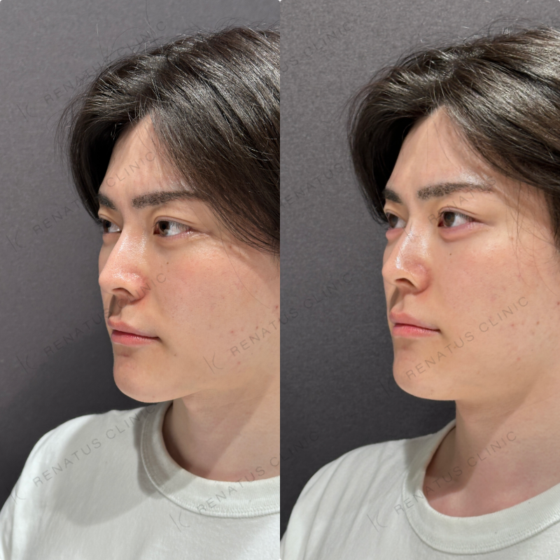 涙袋ヒアルロン酸ボルベラ症例写真