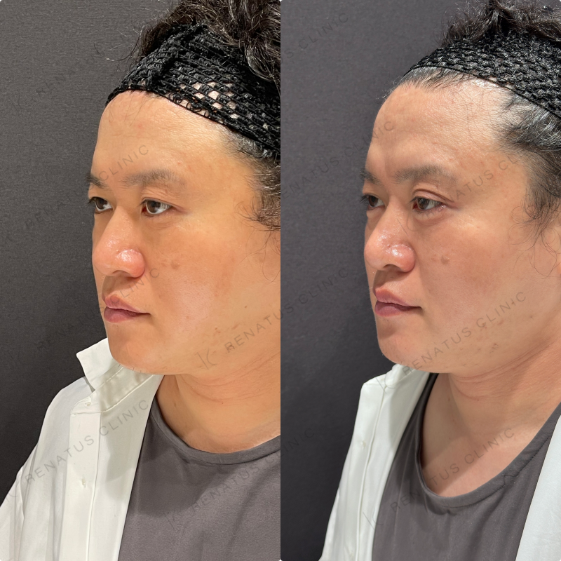 涙袋ヒアルロン酸ボルベラ症例写真