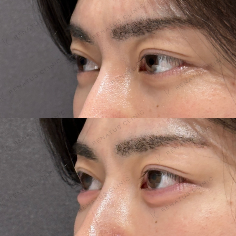 涙袋ヒアルロン酸ボルベラ症例写真