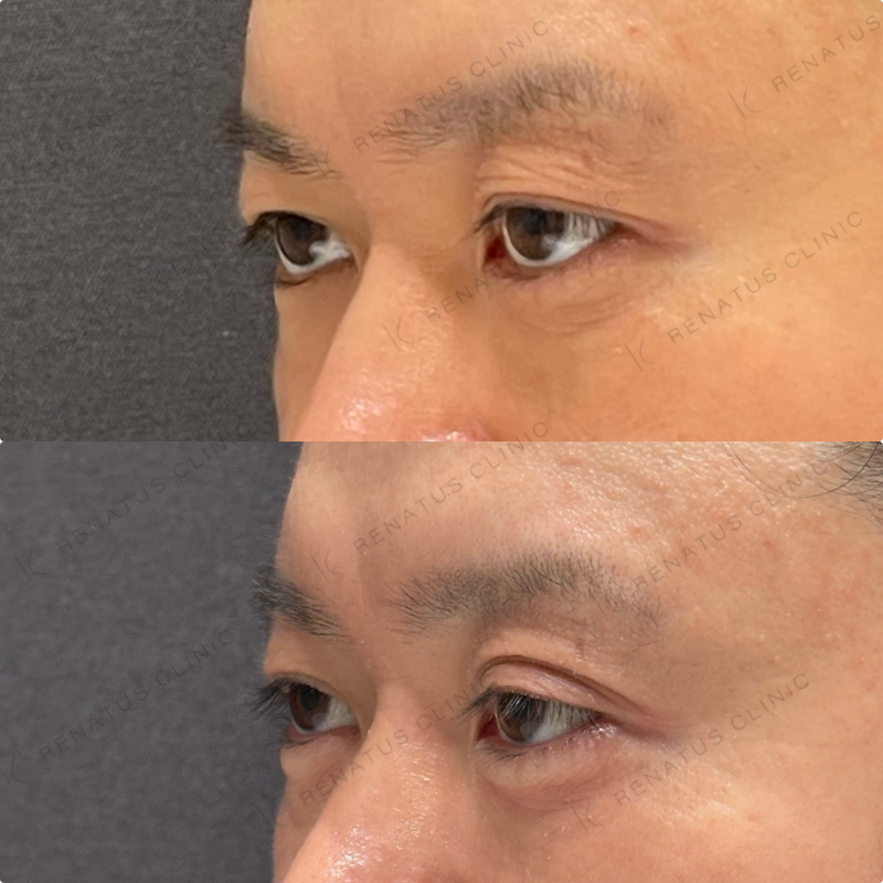 涙袋ヒアルロン酸ボルベラ症例写真