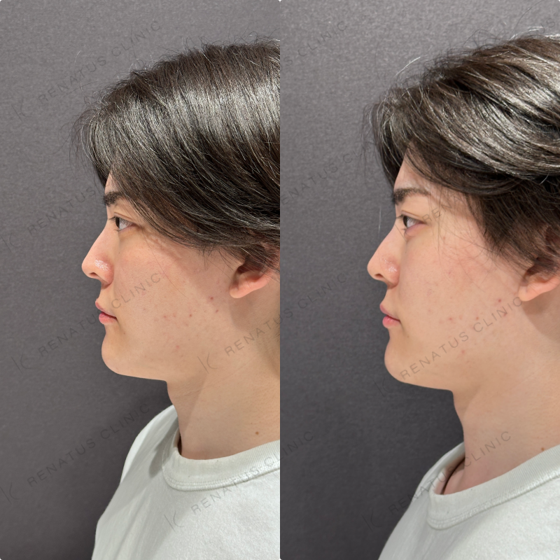 涙袋ヒアルロン酸ボルベラ症例写真