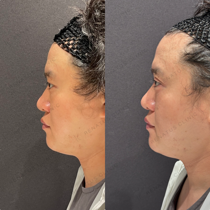 涙袋ヒアルロン酸ボルベラ症例写真