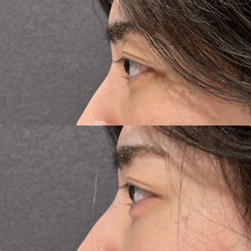 涙袋ヒアルロン酸ボルベラ症例写真