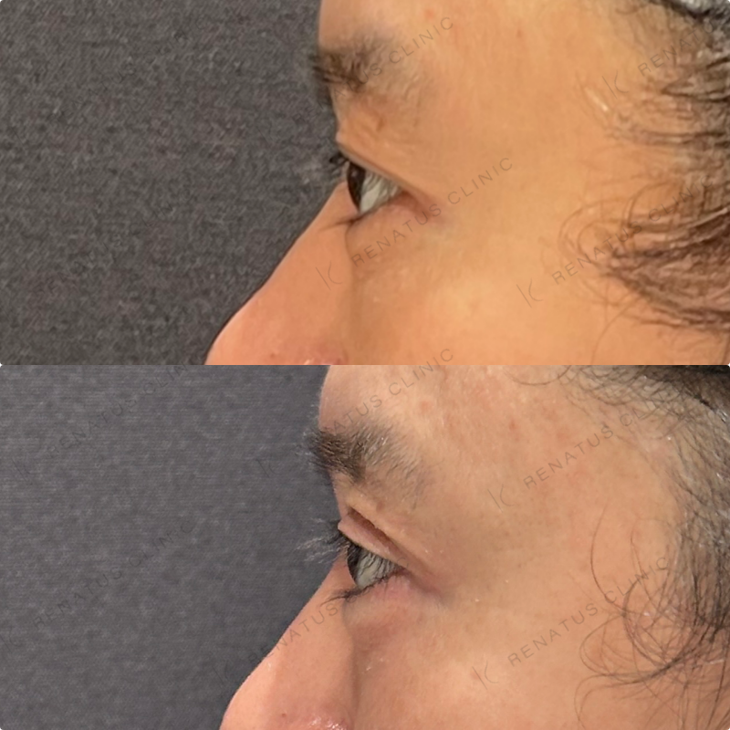 涙袋ヒアルロン酸ボルベラ症例写真