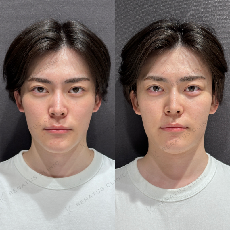 涙袋ヒアルロン酸ボルベラ症例写真