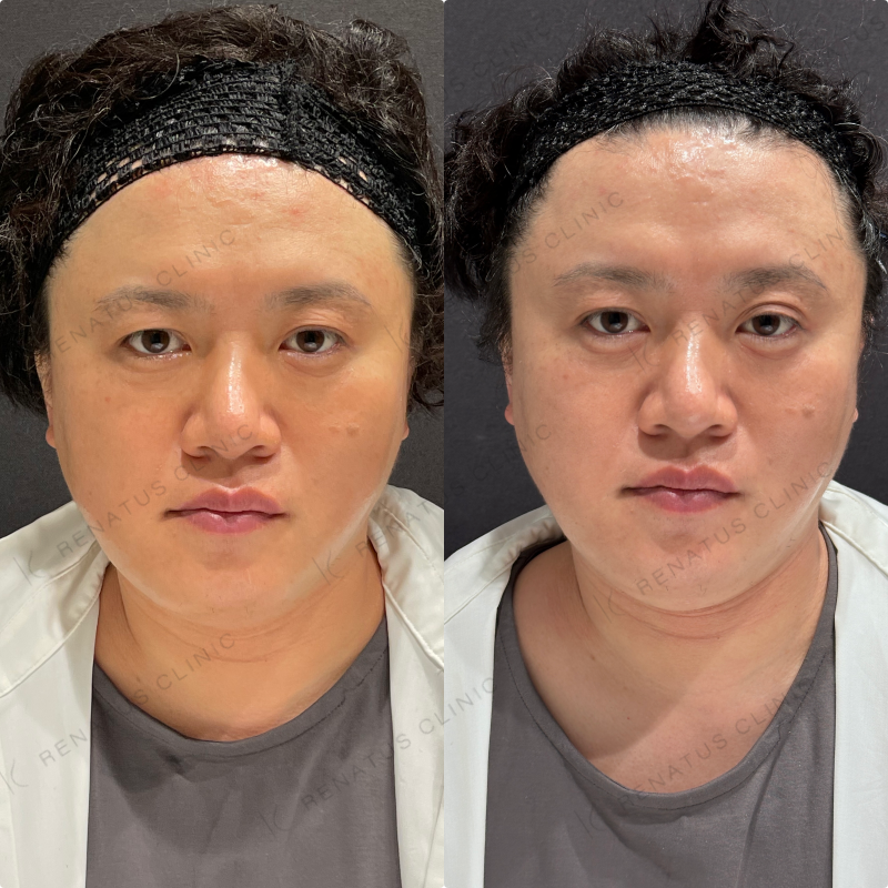 涙袋ヒアルロン酸ボルベラ症例写真