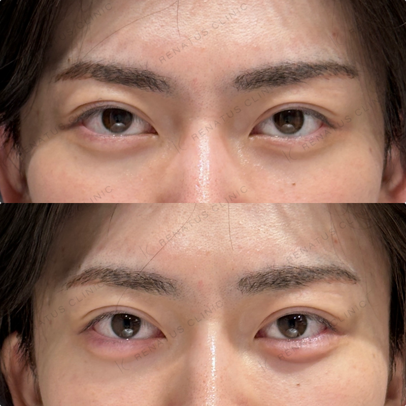 涙袋ヒアルロン酸ボルベラ症例写真