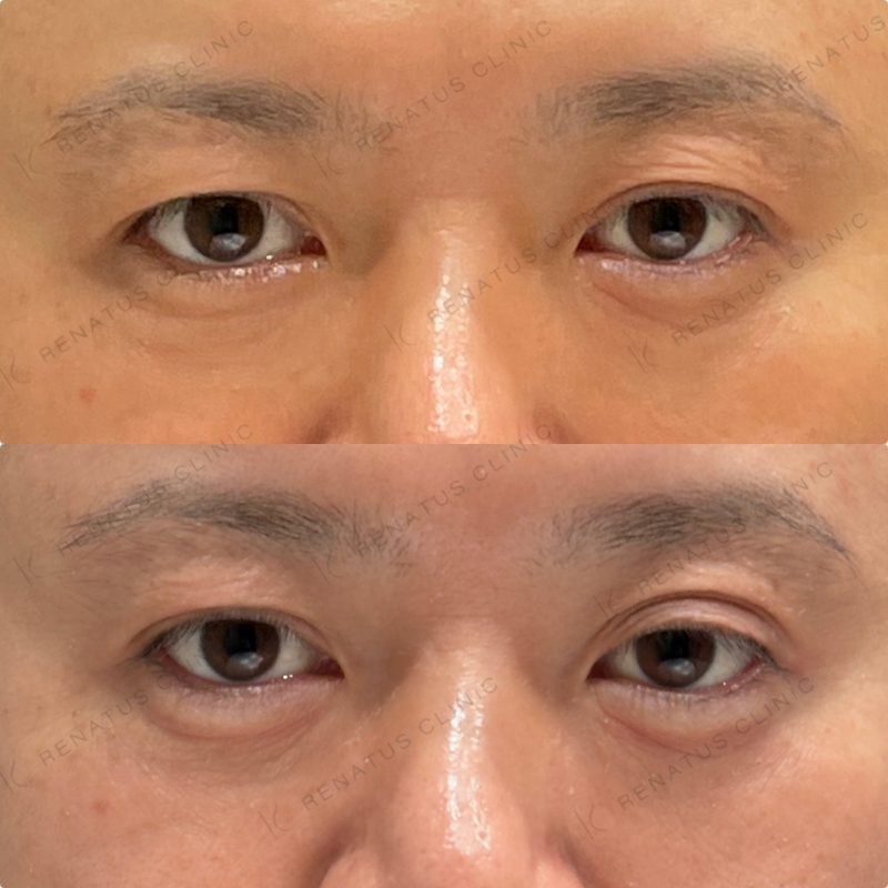 涙袋ヒアルロン酸ボルベラ症例写真