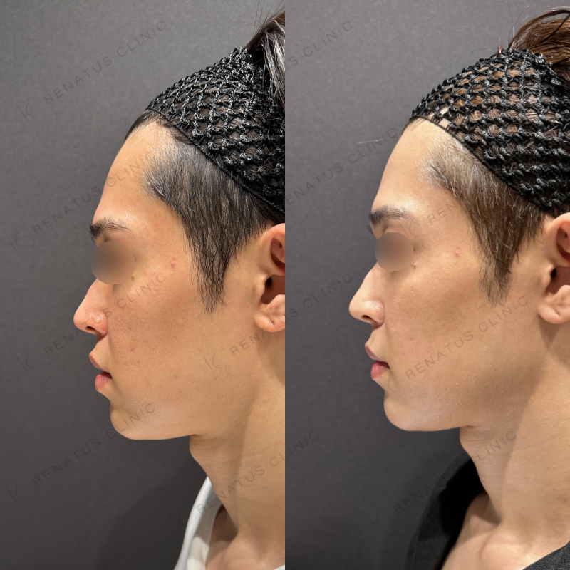 頬ヒアルロン酸ボライト症例写真