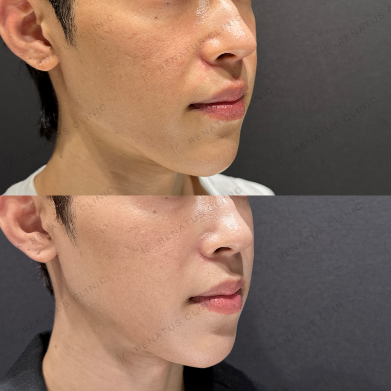 頬ヒアルロン酸ボライト症例写真