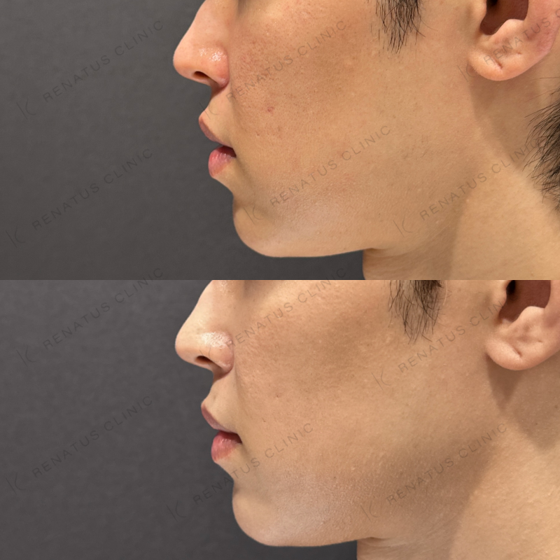 頬ヒアルロン酸ボライト症例写真