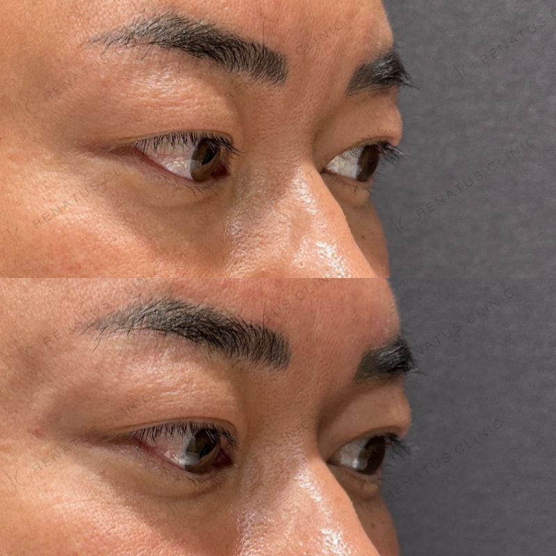 額・こめかみ・目の上ヒアルロン酸ボリューマ・ボライト症例写真