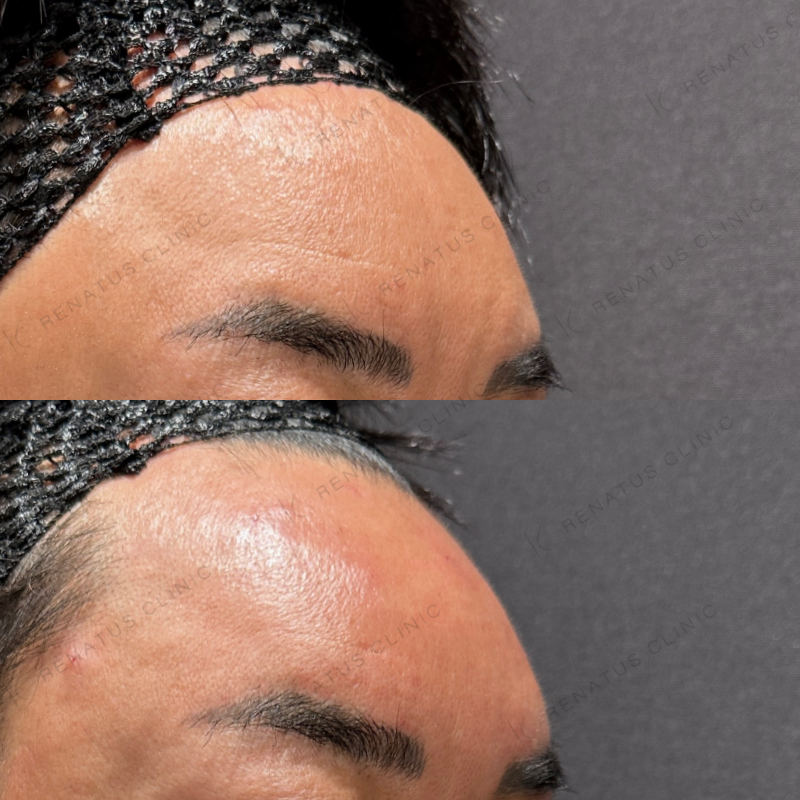 額・こめかみ・目の上ヒアルロン酸ボリューマ・ボライト症例写真