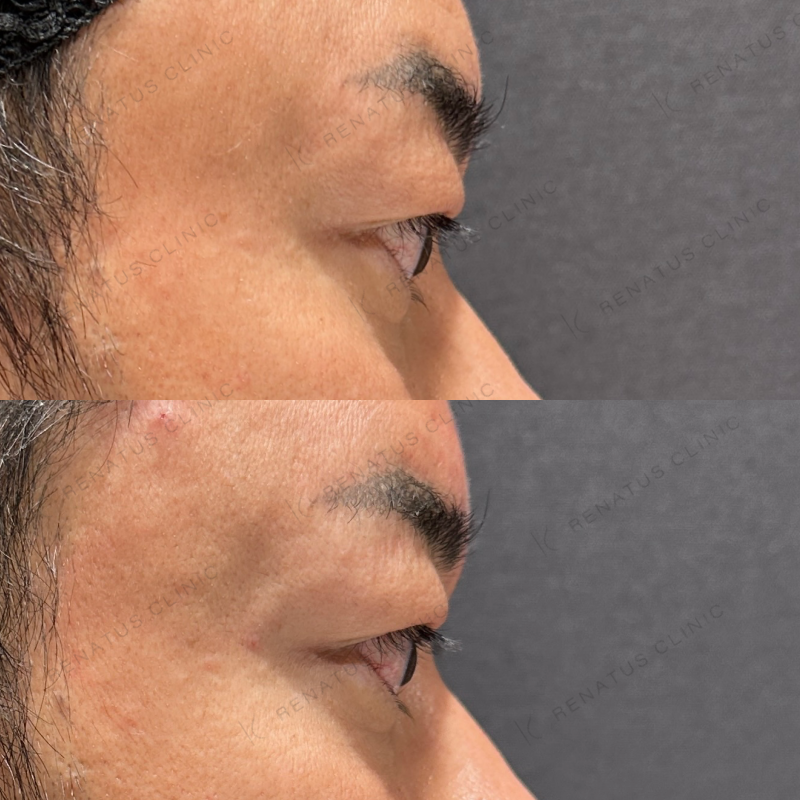 額・こめかみ・目の上ヒアルロン酸ボリューマ・ボライト症例写真