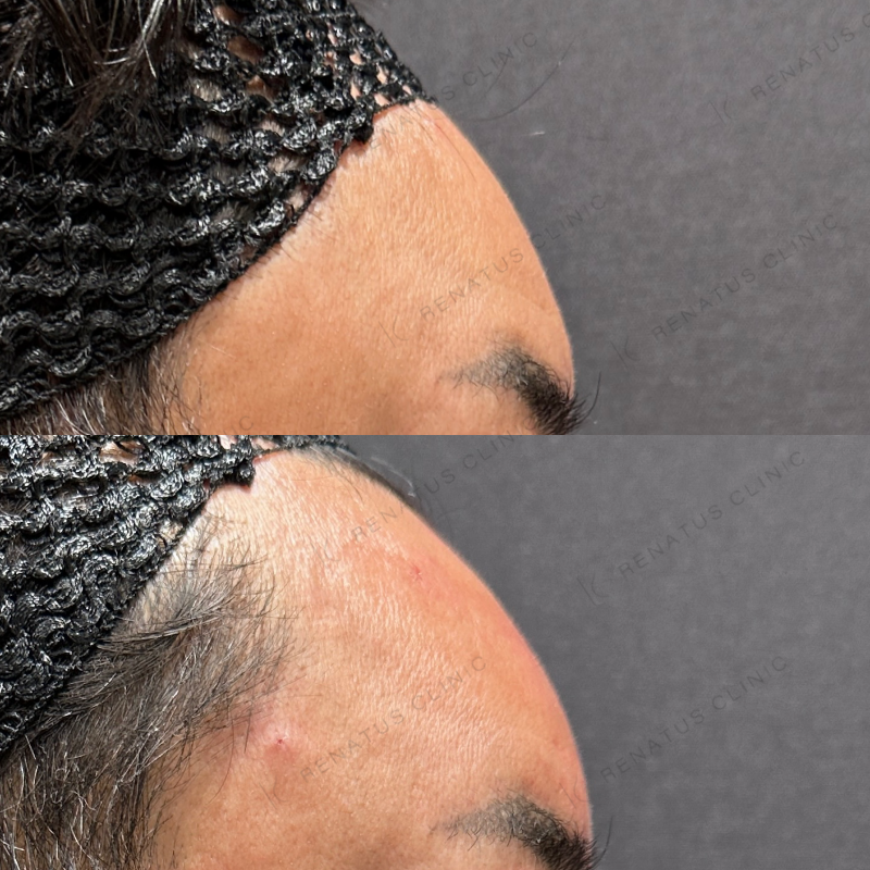 額・こめかみ・目の上ヒアルロン酸ボリューマ・ボライト症例写真