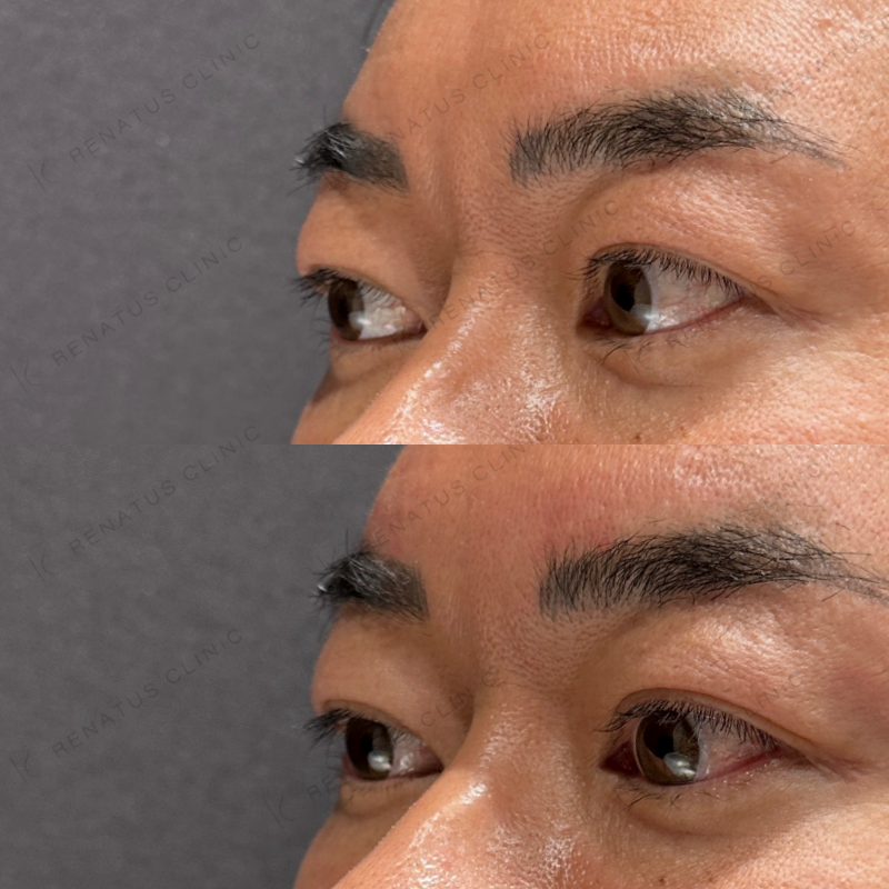 額・こめかみ・目の上ヒアルロン酸ボリューマ・ボライト症例写真