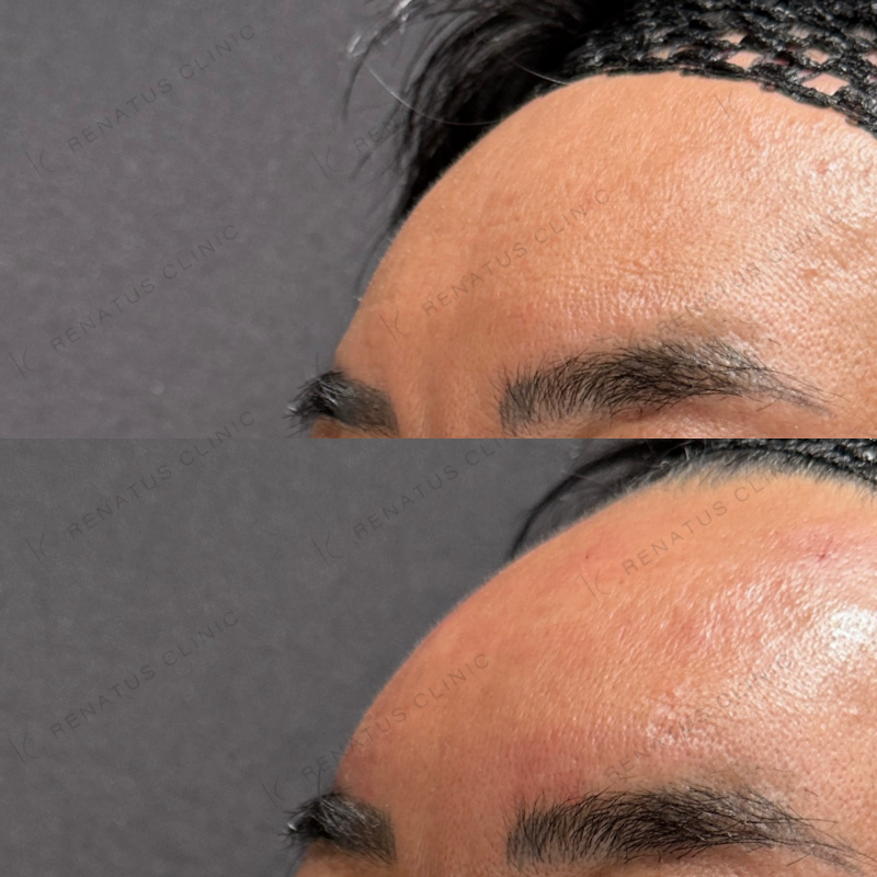 額・こめかみ・目の上ヒアルロン酸ボリューマ・ボライト症例写真