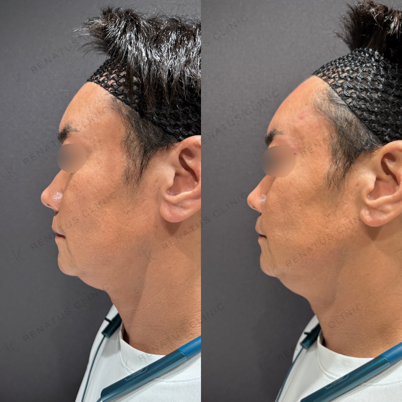 額・こめかみ・目の上ヒアルロン酸ボリューマ・ボライト症例写真