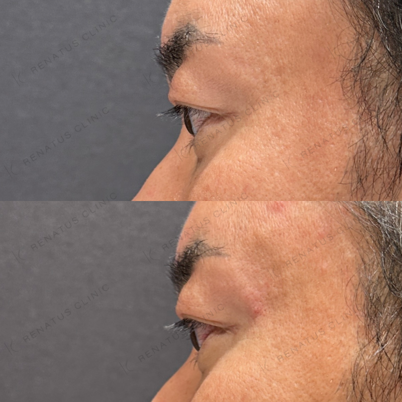 額・こめかみ・目の上ヒアルロン酸ボリューマ・ボライト症例写真