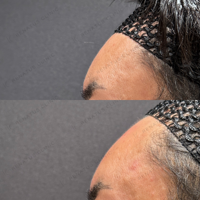 額・こめかみ・目の上ヒアルロン酸ボリューマ・ボライト症例写真