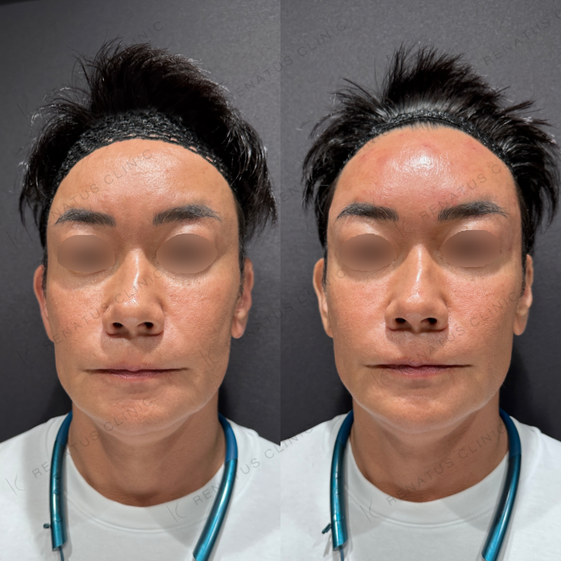 額・こめかみ・目の上ヒアルロン酸ボリューマ・ボライト症例写真