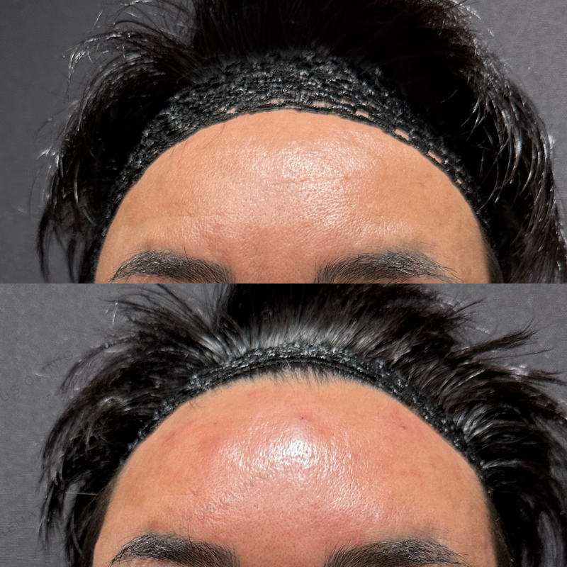 額・こめかみ・目の上ヒアルロン酸ボリューマ・ボライト症例写真