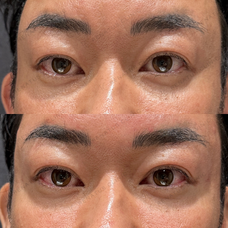 額・こめかみ・目の上ヒアルロン酸ボリューマ・ボライト症例写真