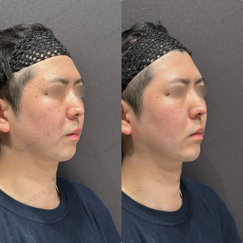 顎ヒアルロン酸ボラックス症例写真