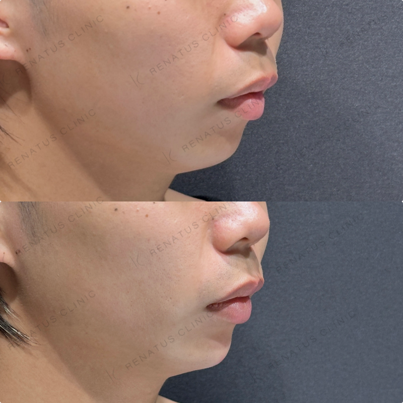 顎ヒアルロン酸ボラックス症例写真