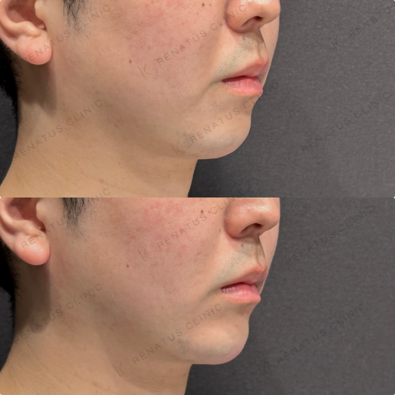 顎ヒアルロン酸ボラックス症例写真