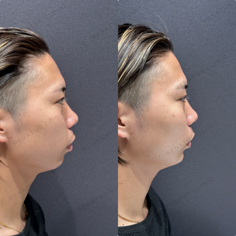 顎ヒアルロン酸ボラックス症例写真