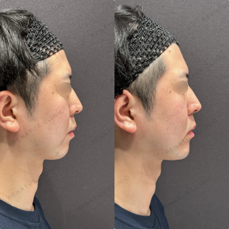 顎ヒアルロン酸ボラックス症例写真