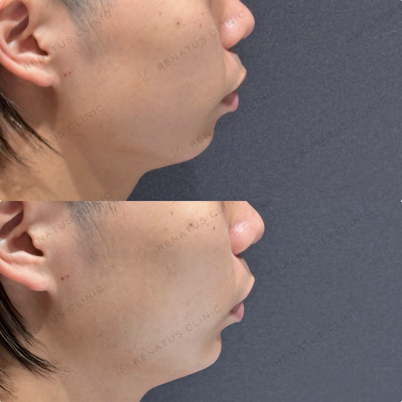 顎ヒアルロン酸ボラックス症例写真