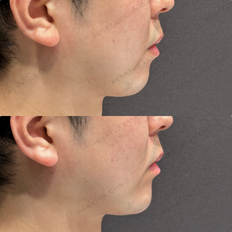 顎ヒアルロン酸ボラックス症例写真