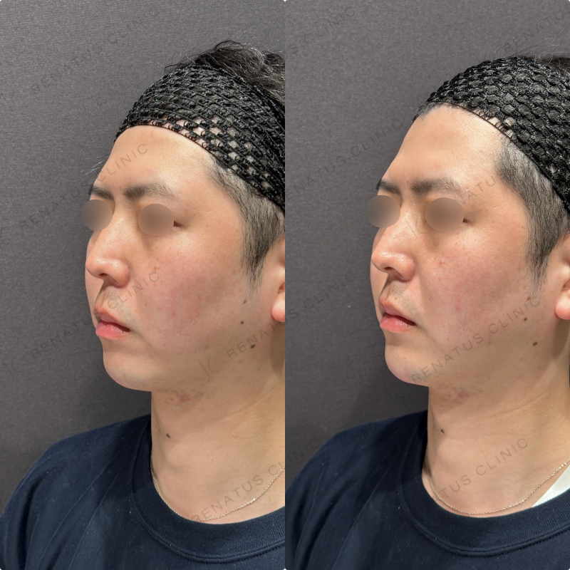 顎ヒアルロン酸ボラックス症例写真