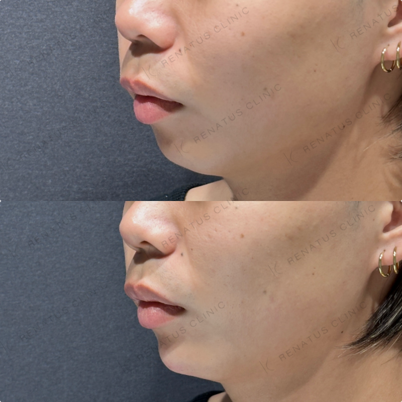 顎ヒアルロン酸ボラックス症例写真