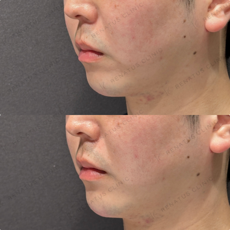 顎ヒアルロン酸ボラックス症例写真