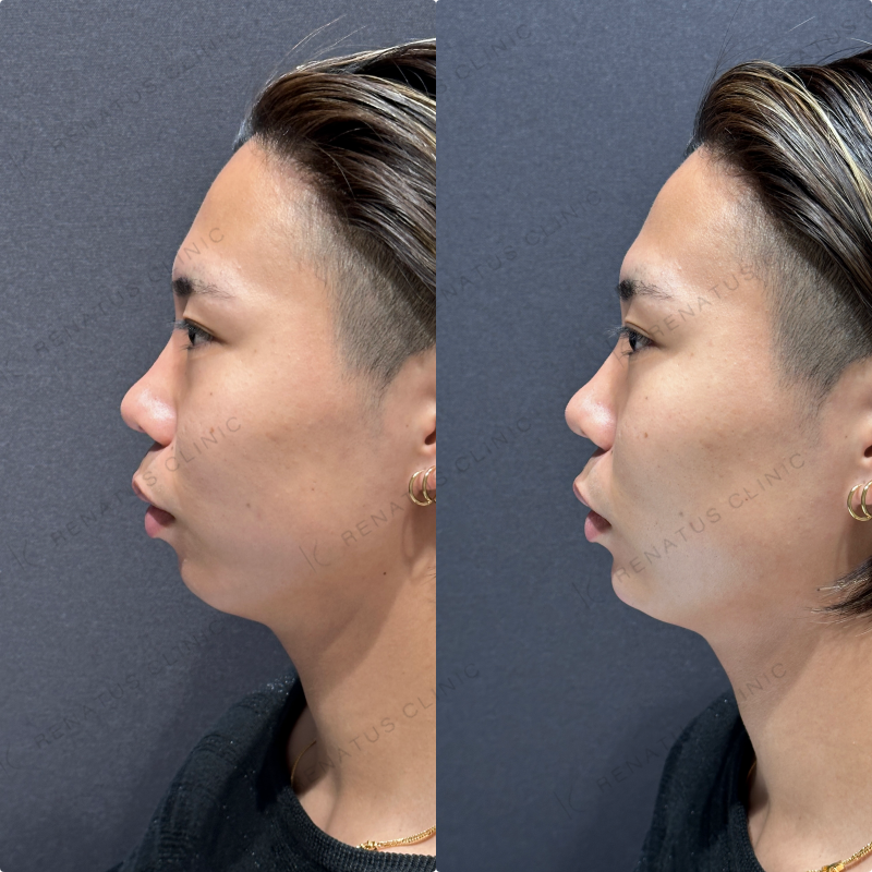 顎ヒアルロン酸ボラックス症例写真