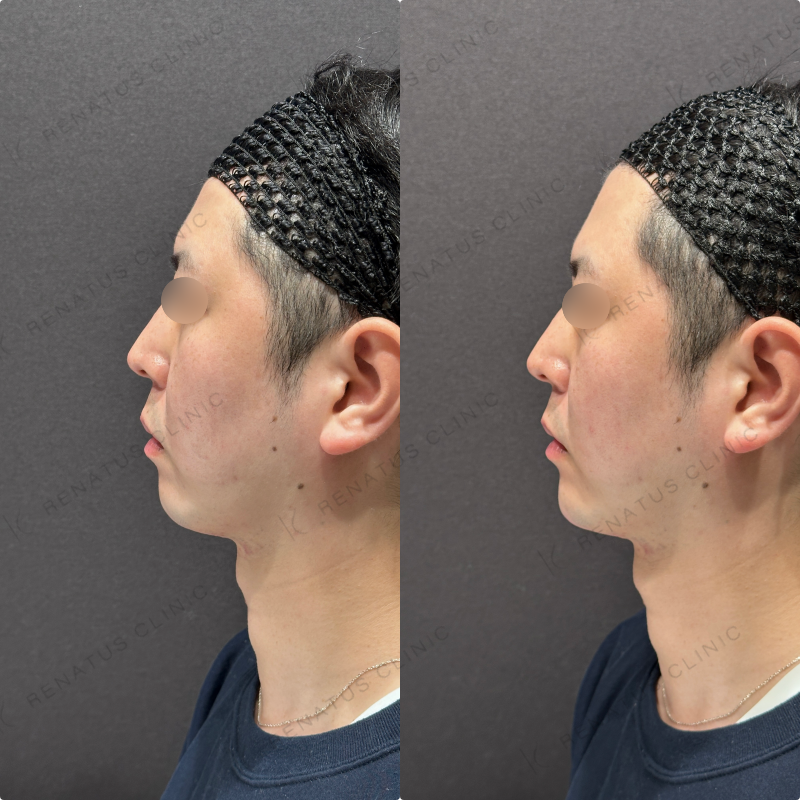 顎ヒアルロン酸ボラックス症例写真